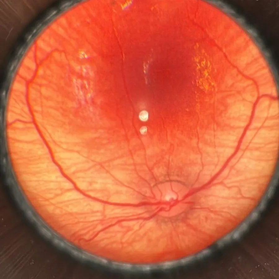 retuna fundus2