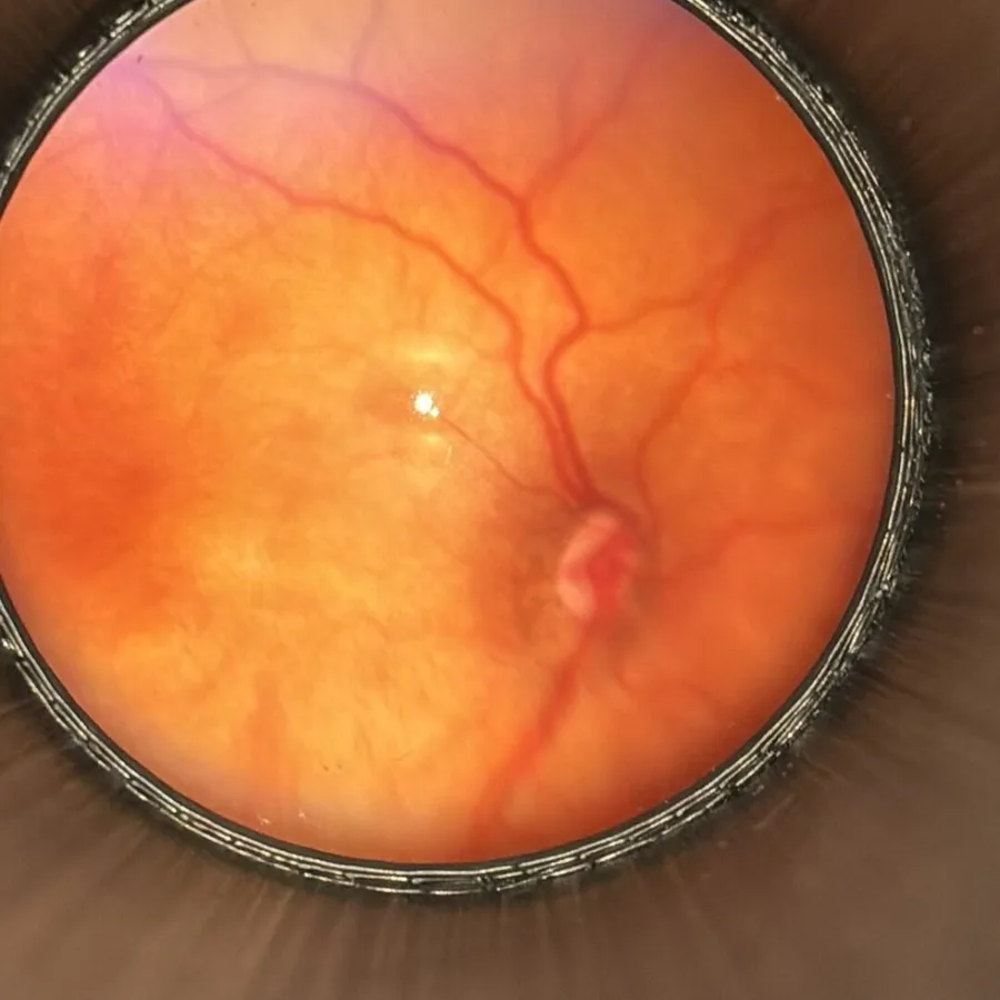 Optik disk · EyeMag